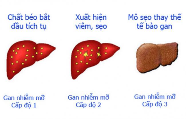 Gan nhiễm mỡ độ 1, mức độ nguy hiểm và cách điều trị